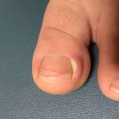 足の親指の腫れ 足の親指の付け根が痛い…外反母趾ではないのに何故？ [運動と健康]